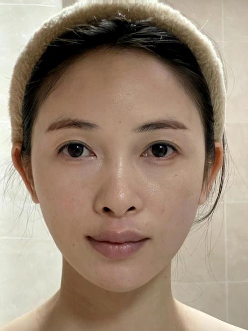 玻尿酸注射:美丽新趋势