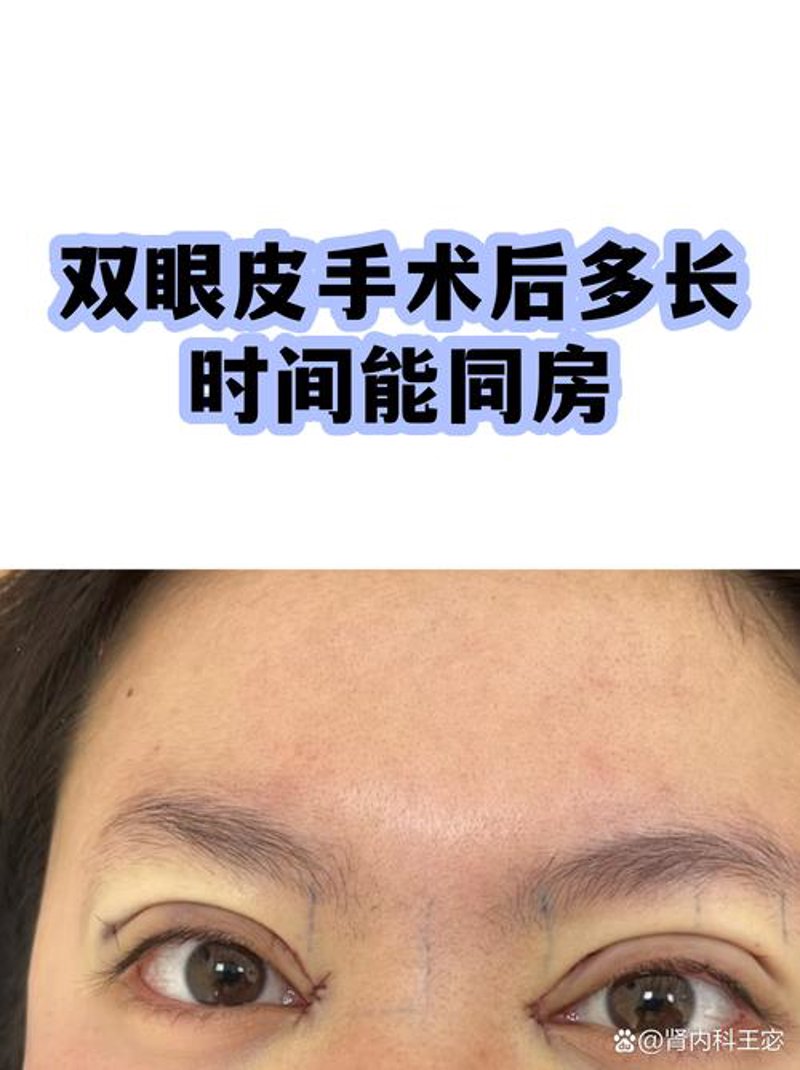玻尿酸注射:现代美容趋势的新风向标