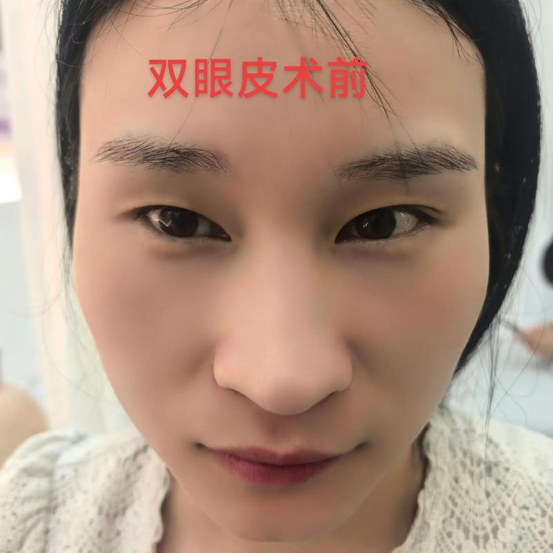 隆鼻整形：塑造完美桥梁的艺术之旅